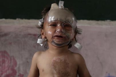 İsrail saldırılarında ağır yaralanan çocuk tedavi bekliyor